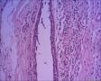 伴有骨巨细胞的化生性癌？右侧乳腺包块，求会诊图36