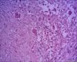 伴有骨巨细胞的化生性癌？右侧乳腺包块，求会诊图27