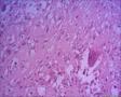 伴有骨巨细胞的化生性癌？右侧乳腺包块，求会诊图31