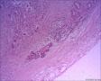 伴有骨巨细胞的化生性癌？右侧乳腺包块，求会诊图13