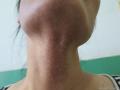 小草典型病例之六------面颈部、腹部色素斑、痒图1
