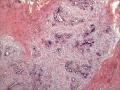 乳腺包块，是发腺病瘤合适还是发纤维腺瘤呢？图19