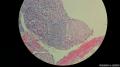 子宫颈糜烂伴鳞化(间质内几团细胞？）图27