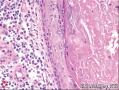 良性腺样包含体导致乳腺癌患者前哨淋巴结假阳性：3例报道并文献复习图5