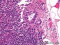 良性腺样包含体导致乳腺癌患者前哨淋巴结假阳性：3例报道并文献复习图6