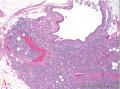 良性腺样包含体导致乳腺癌患者前哨淋巴结假阳性：3例报道并文献复习图1