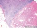 良性腺样包含体导致乳腺癌患者前哨淋巴结假阳性：3例报道并文献复习图4
