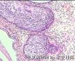 宫颈CIN3，局部够癌吗？与前一例同一病人图3