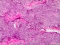 请问这个是纤维肉瘤还是毛母细胞瘤图2