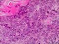 请问这个是纤维肉瘤还是毛母细胞瘤图1