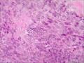 请问这个是纤维肉瘤还是毛母细胞瘤图4