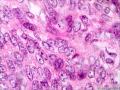 请问这个是纤维肉瘤还是毛母细胞瘤图5