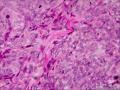 请问这个是纤维肉瘤还是毛母细胞瘤图3