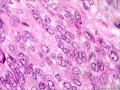 请问这个是纤维肉瘤还是毛母细胞瘤图6