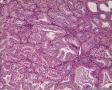 左侧卵巢肿瘤及子宫内膜肿瘤图9
