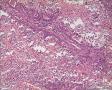 左侧卵巢肿瘤及子宫内膜肿瘤图11