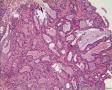 左侧卵巢肿瘤及子宫内膜肿瘤图17