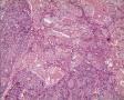 左侧卵巢肿瘤及子宫内膜肿瘤图14