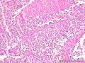 少见肿瘤，起初从形态学考虑神经内分泌肿瘤，结果免疫组化不支持，最后诊断间质瘤图11