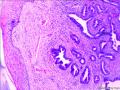 子宫内膜样腺癌图2