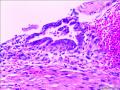 子宫内膜样腺癌图15