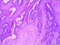 子宫内膜样腺癌图6