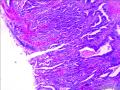 子宫内膜样腺癌图3