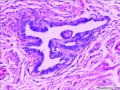 子宫内膜样腺癌图16