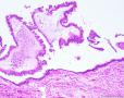 卵巢肿物图12