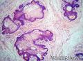 女性下生殖道非HPV相关性腺癌及其前驱病变的最新进展图13