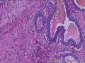 乳腺纤维瘤，血管丰富，如何诊断图4