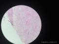 请问这个是纤维肉瘤还是毛母细胞瘤图7