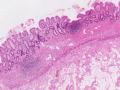 炎症性肠病 | 上皮细胞和粘膜间质图12