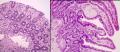 炎症性肠病 | 上皮细胞和粘膜间质图15