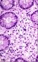 炎症性肠病 | 上皮细胞和粘膜间质图11