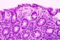 炎症性肠病 | 上皮细胞和粘膜间质图14
