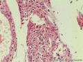 宫颈赘生物  上皮是修复性改变还是有上皮内病变？图16