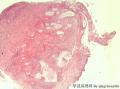 宫颈赘生物  上皮是修复性改变还是有上皮内病变？图4