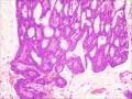 伴有筛状及乳头状结构的浸润性导管癌图5