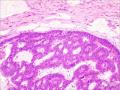 伴有筛状及乳头状结构的浸润性导管癌图2