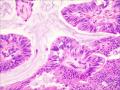 伴有筛状及乳头状结构的浸润性导管癌图1