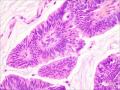 伴有筛状及乳头状结构的浸润性导管癌图7