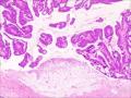 伴有筛状及乳头状结构的浸润性导管癌图3