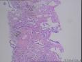 右肺上叶肿物，请大家会诊，细胞异型很小，是贴壁状腺癌？需要和其他肿瘤鉴别吗？图3