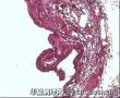 附睾肿物图2