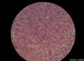 甲状腺肿瘤 梭形细胞肿瘤图15
