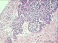 毛母细胞瘤？基底细胞癌？。。。。。。。。。。。。。。。。。。。。。。。。。。。图8