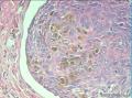 毛母细胞瘤？基底细胞癌？。。。。。。。。。。。。。。。。。。。。。。。。。。。图9