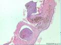 毛母细胞瘤？基底细胞癌？。。。。。。。。。。。。。。。。。。。。。。。。。。。图2