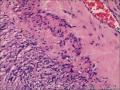 肾血管平滑肌脂肪瘤图17